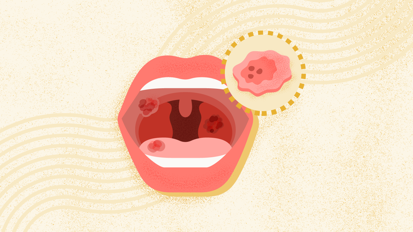 Oral Cancer