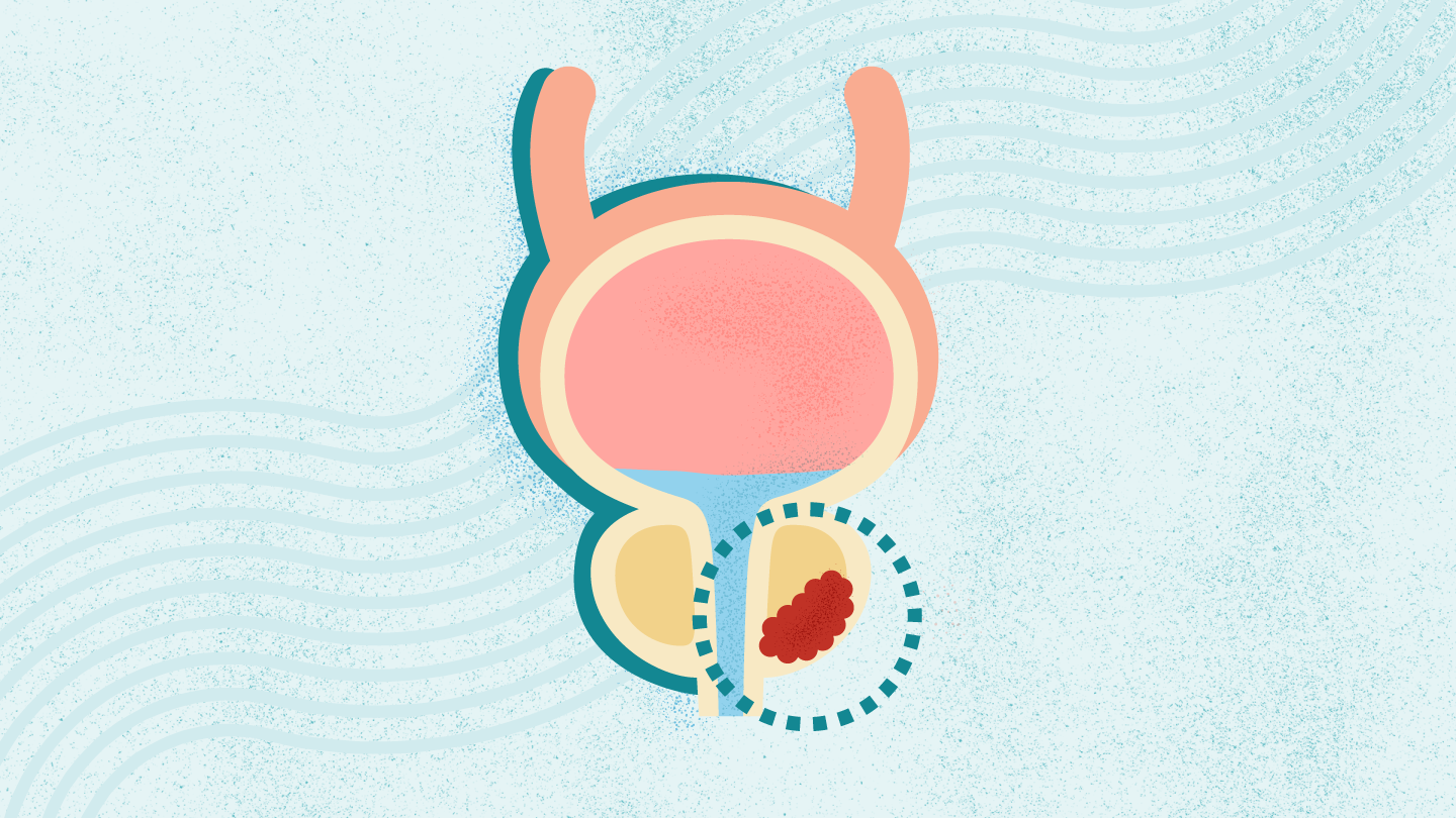 Prostate Cancer