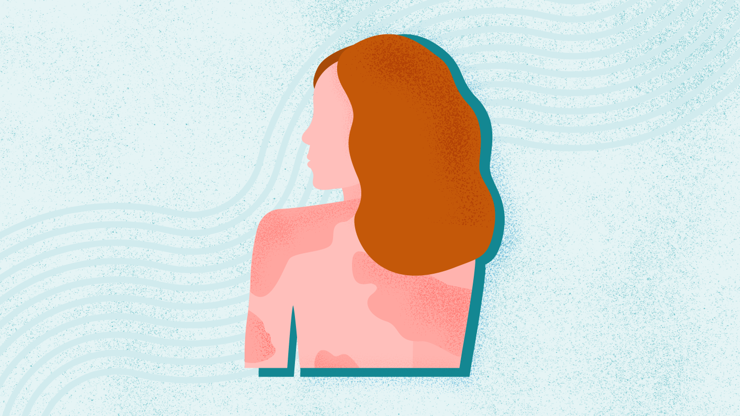 Psoriasis