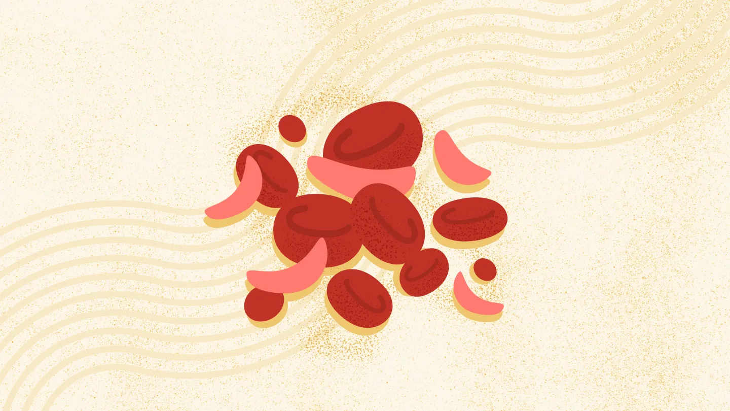 Sickle Cell Anemia