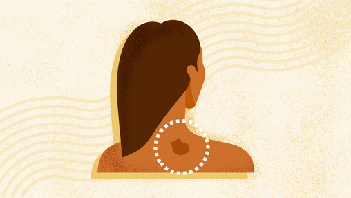 What Is Skin Cancer? Signs, Symptoms, Treatment, and More