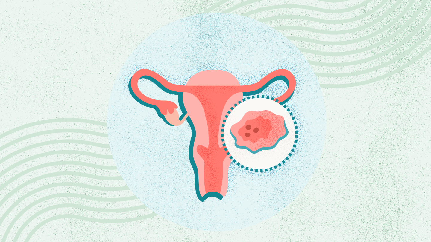 Uterine Cancer