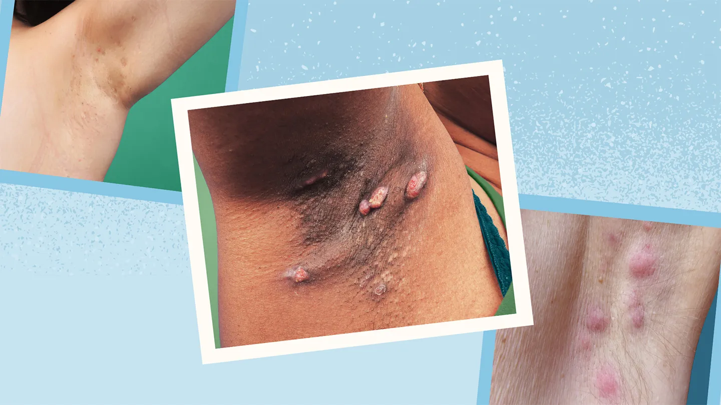 different hidradenitis suppurativa