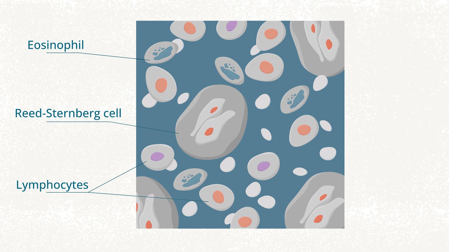 People with Hodgkin lymphoma have a mutated lymphocyte called a Reed-Sternberg cell.