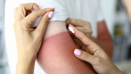 Try These 7 At-Home Sunburn Treatments to Save Your Vacation