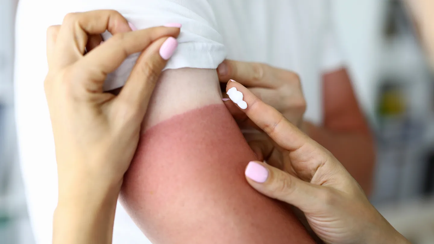 Feminine hands apply lotion to severe sunburn on an arm of another person