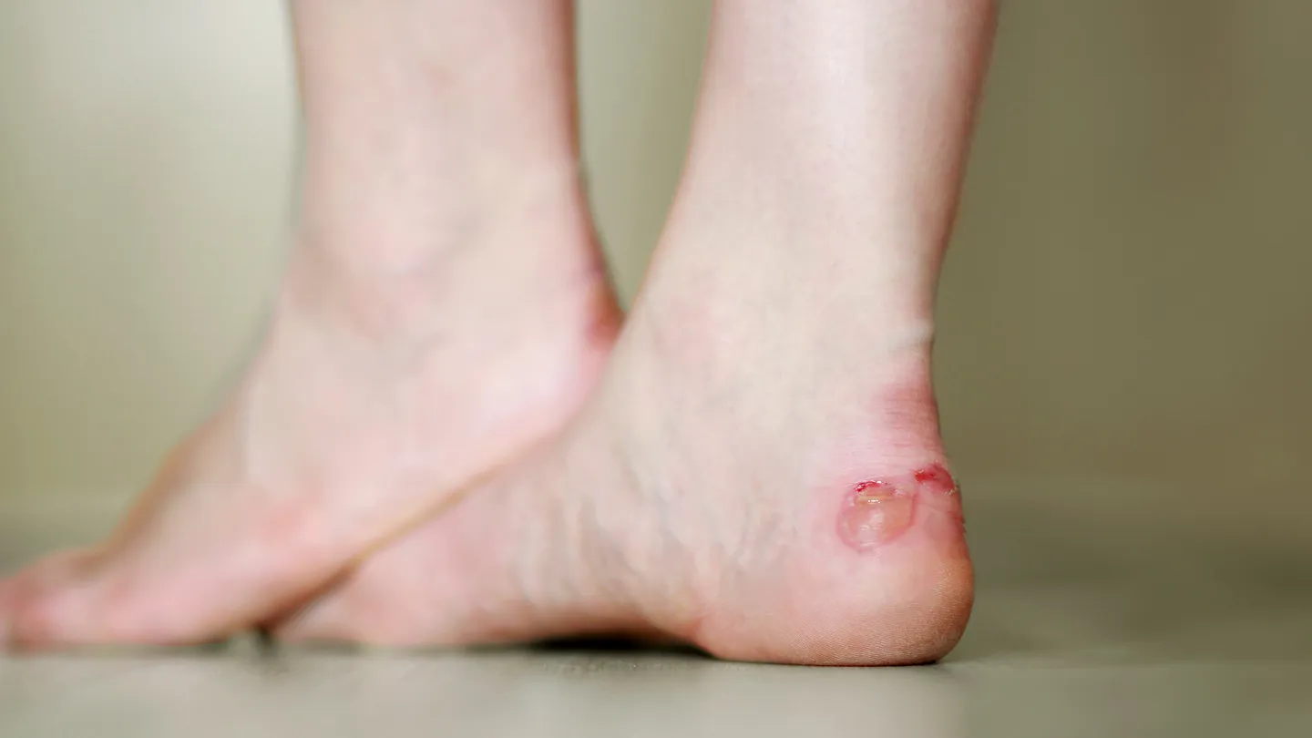 infected blisters on woman's heel
