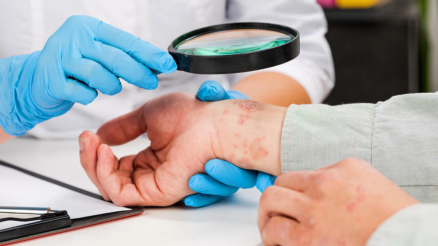 doctor examining skin hand eczema