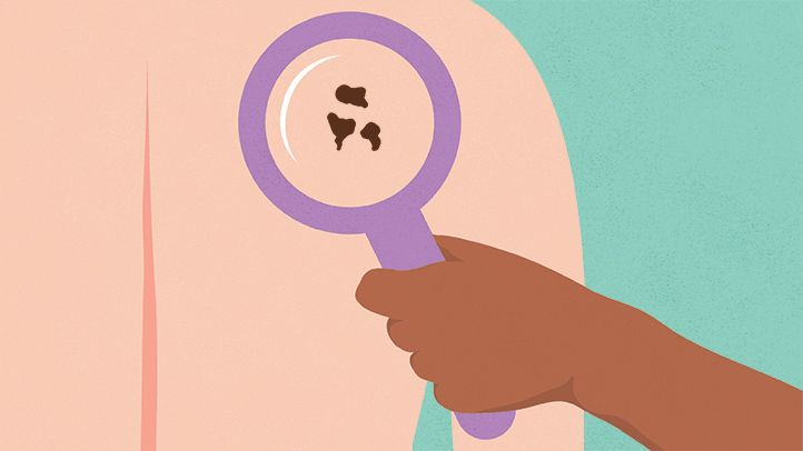 illustration magnifying glass melanoma back skin