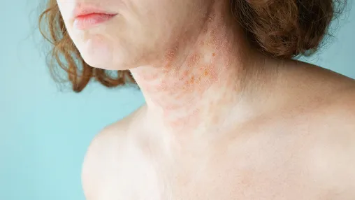 How Long Does Eczema or an Eczema Flare Last?