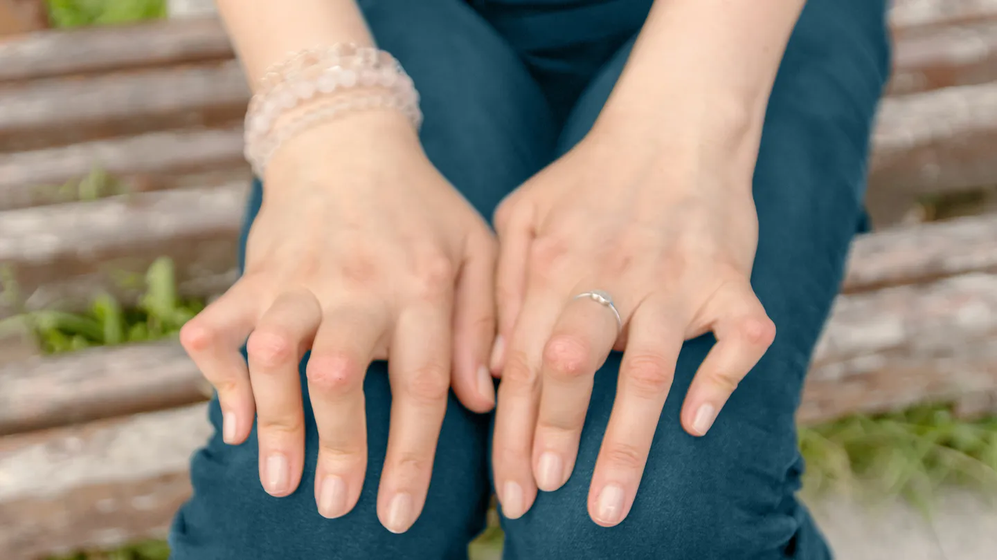 Young woman with rheumatoid arthritis nodules on her hands