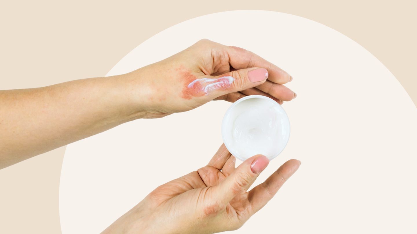 hands with eczema -Corticosteroid cream or ointment