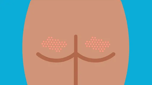 Butt Acne: How to Get Rid of the Bumps on Your Behind
