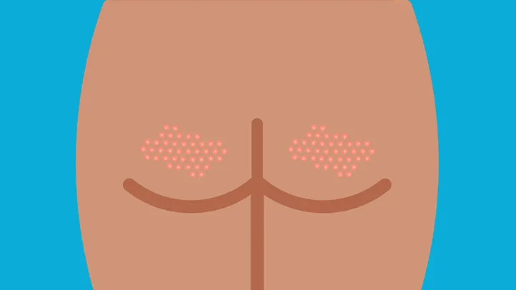 butt acne buttne illustration