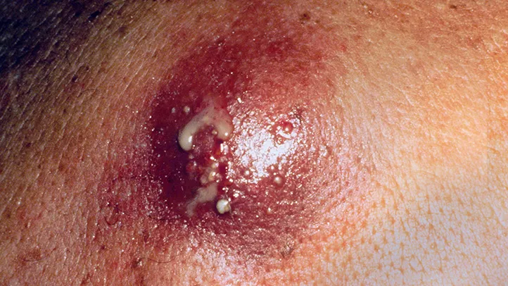 How-to-Deal-With-Buttocks-Breakouts-Carbuncles-02-RM-722x406