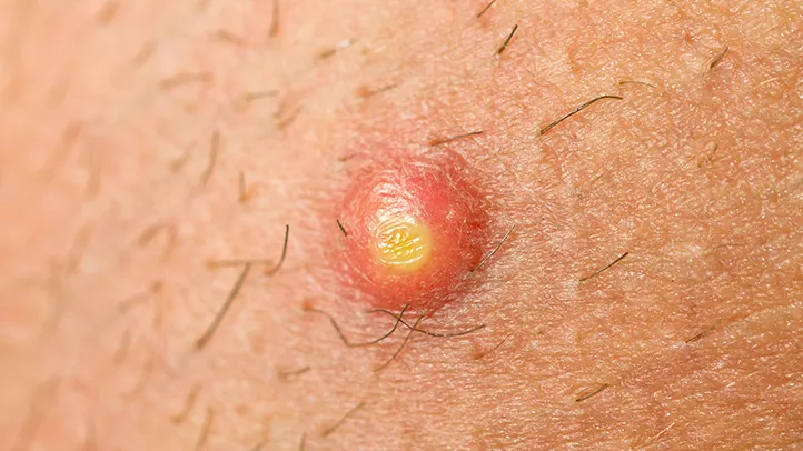 How-to-Deal-With-Buttocks-Breakouts-Folliculitis-01-722x406