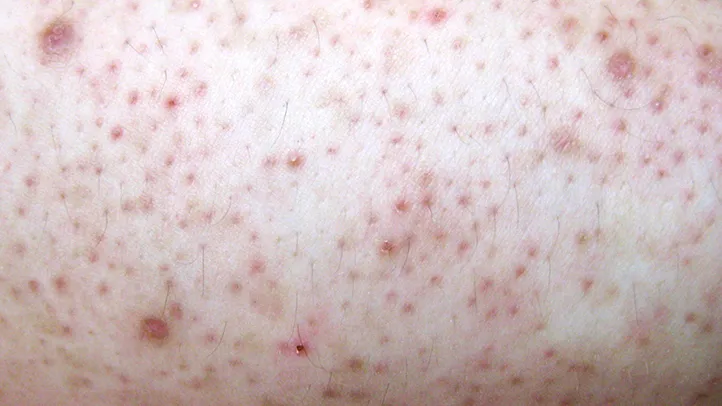 How-to-Deal-With-Buttocks-Breakouts-Keratosis-Pilaris-03-722x406