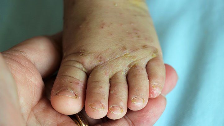 Small, raised red spots and a persistent itch often indicate a scabies infection.