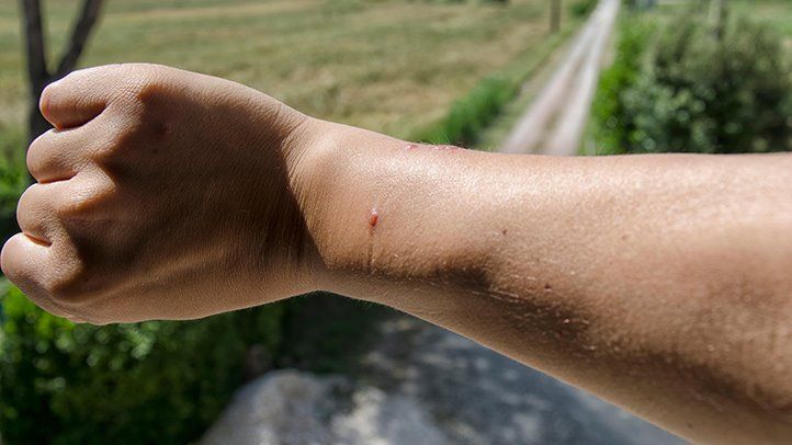 How to Know When a Spider Bites and What to Do About It