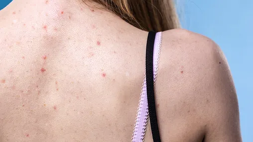 Back Acne (‘Bacne’): Why Pimples Pop Up and How to Prevent and Get Rid of Them