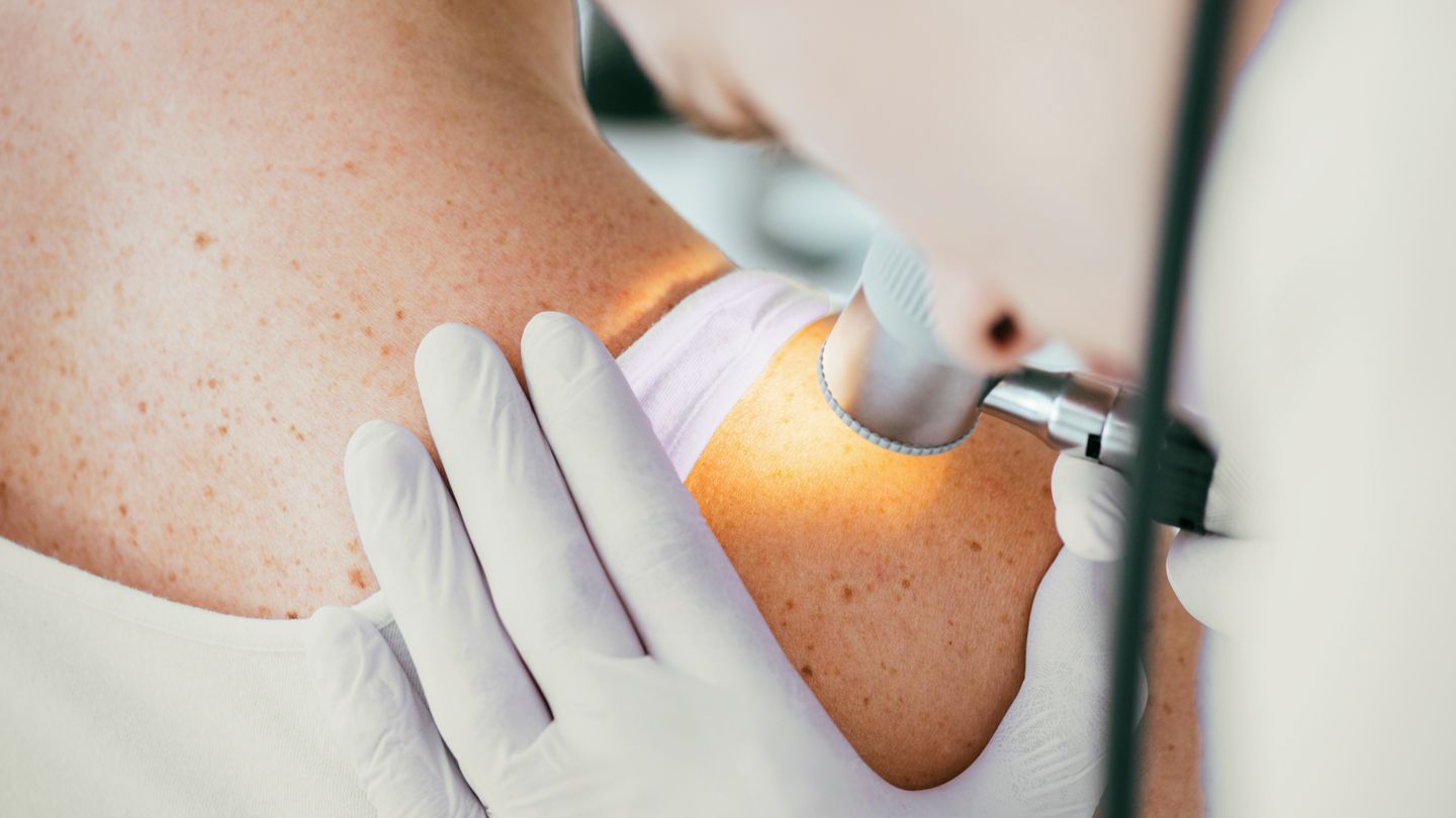 dermatologist holding dermatoscope while examining woman with melanoma