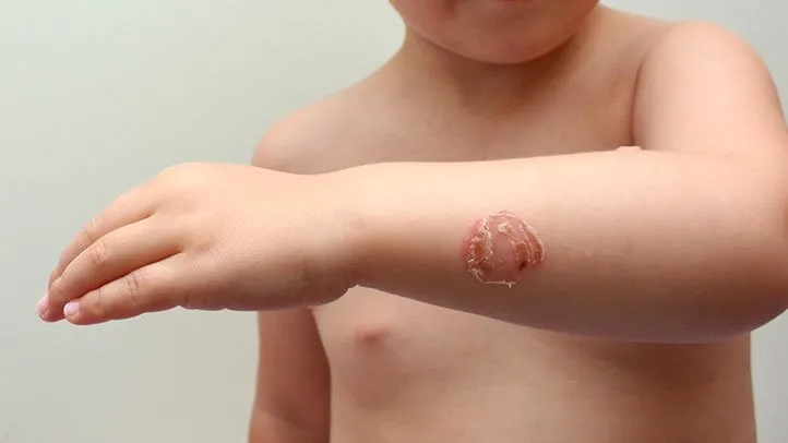 a child with impetigo that is at risk of complications