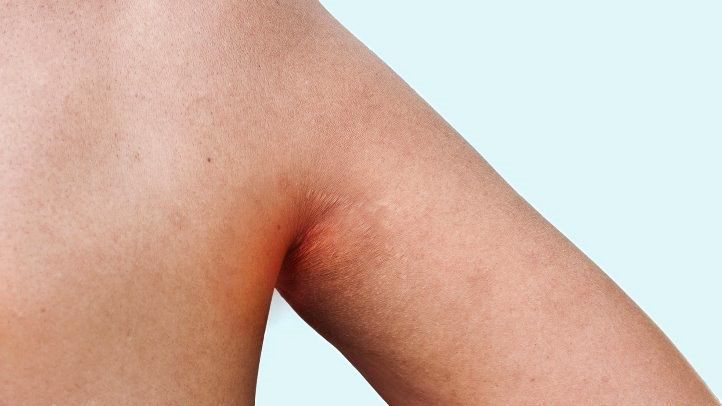 inverse psoriasis in skin folds of the armpits