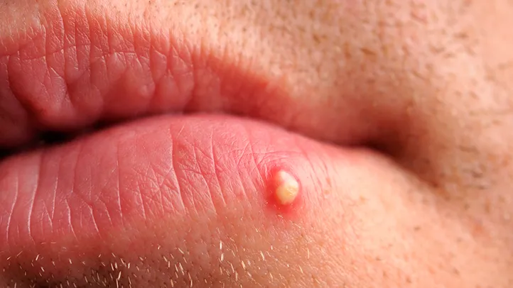 Is That Spot a Pimple or a Cold Sore acne zit white head