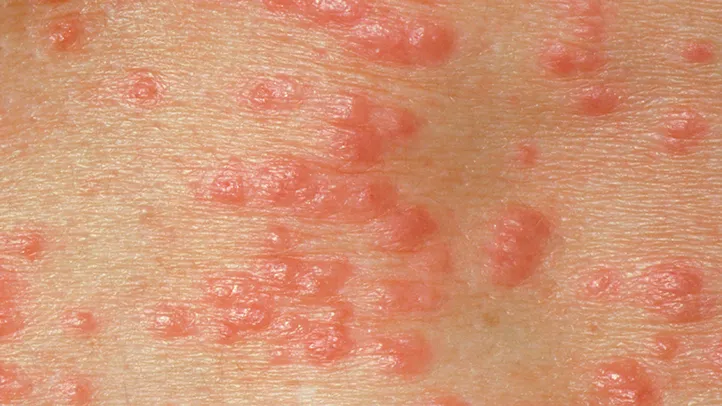 Scabies or Herpes tiny eight-legged itch mites burrow into the skin feed lay their eggs