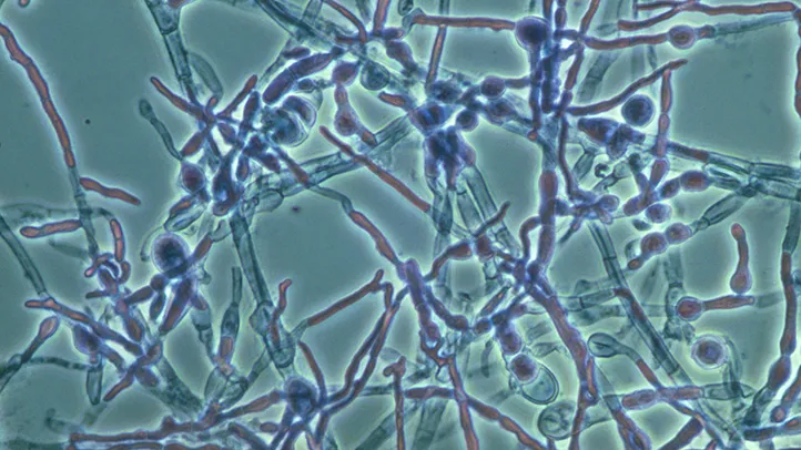 Yeast Infection or STD herpes thrush candida albicans Candidiasis