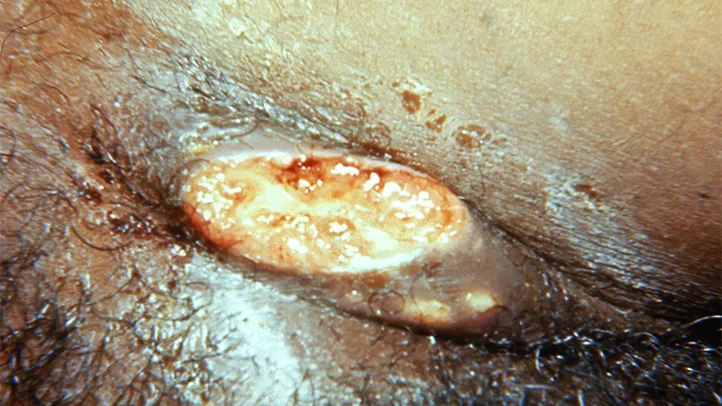 Chlamydia the Most Common STD  bacteria