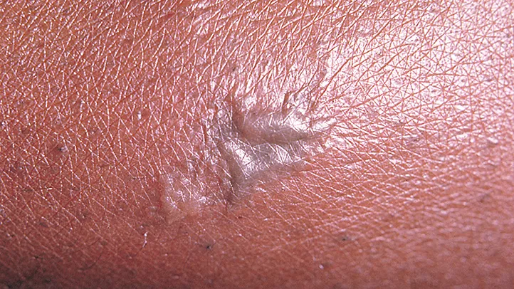 gonorrhea STD sores genital area skin rash and burning pain when urinating