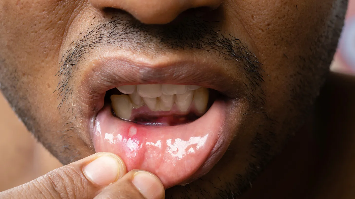 South East Asian man with canker sore inside his lower lip