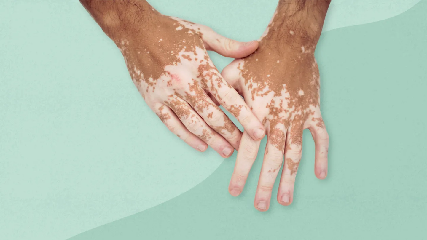 Hands Vitiligo