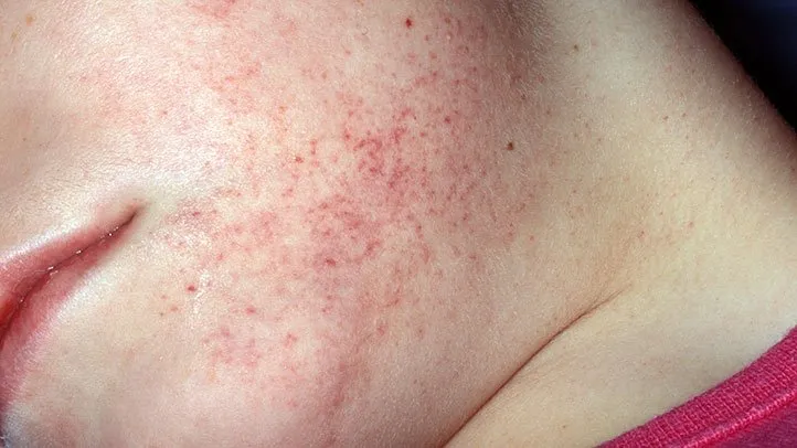 petechiae