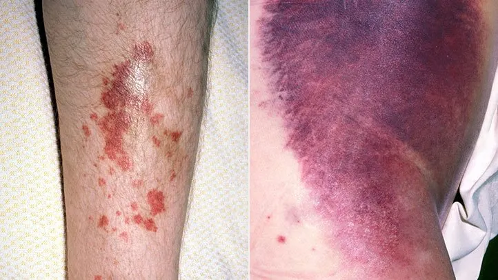 bleeding under the skin