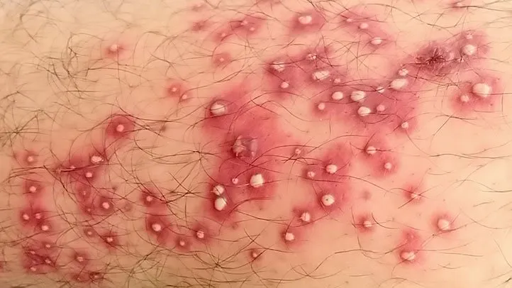Folliculitis