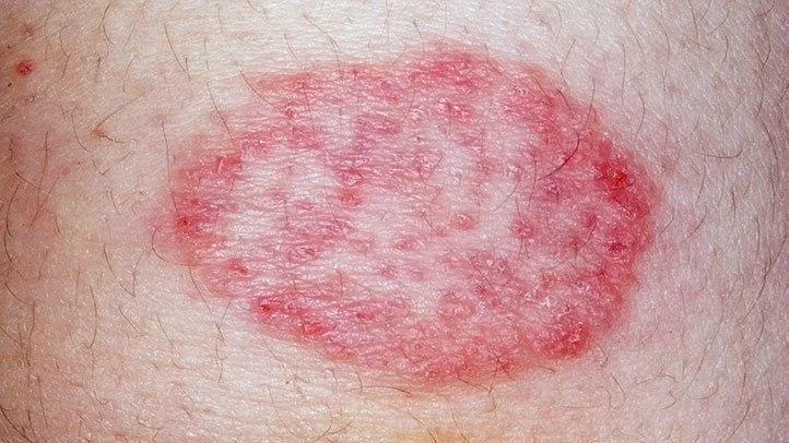 ringworm
