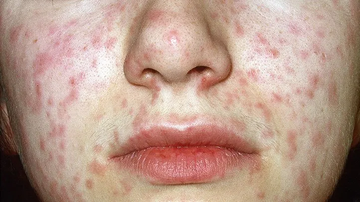 Morbilliform drug eruption