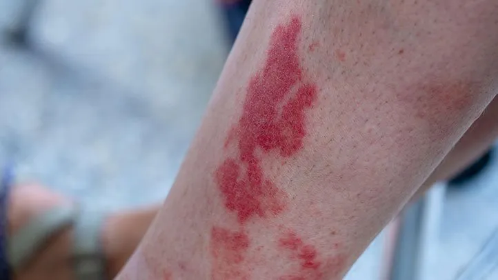 Vasculitis