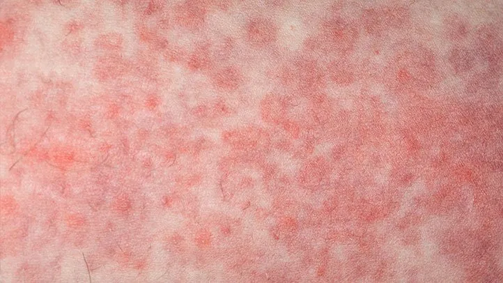 chemo rashes