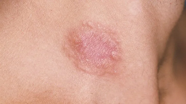 Sweet’s Syndrome Rash