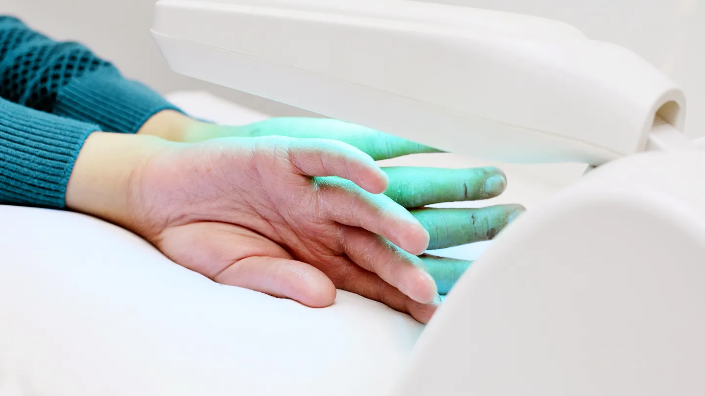 hands of a patient with psoriasis close-up under an ultraviolet lamp