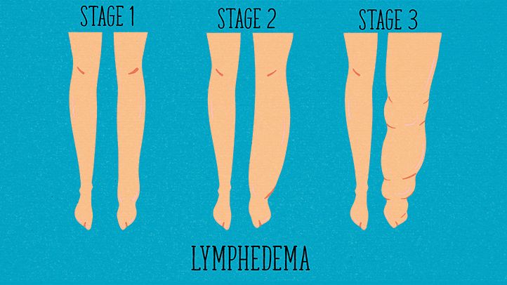 The fluid buildup leads to swelling in the arms or legs when the lymph nodes are damaged or removed