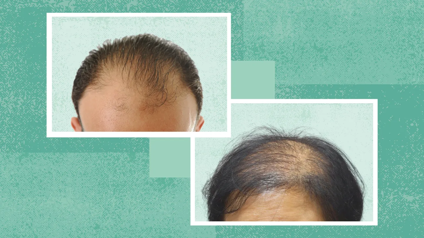 Male-vs-Female-Pattern-Baldness-1440x810