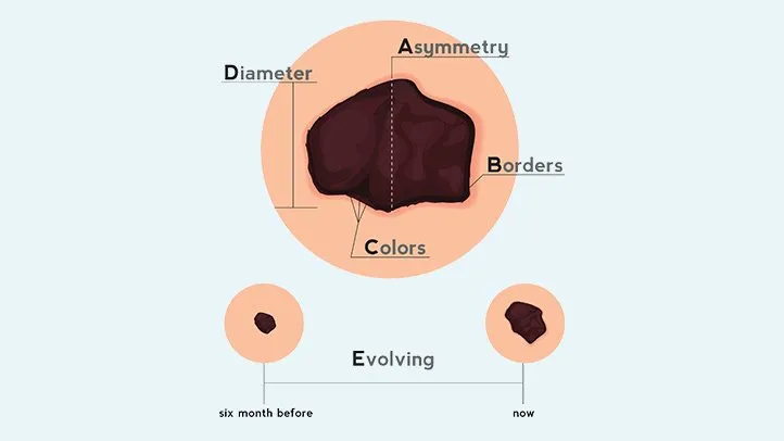 Dermatologists use the ABCDE system to examine suspicious moles.