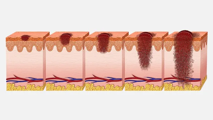 Melanoma Stages: Defining How Advanced It Is