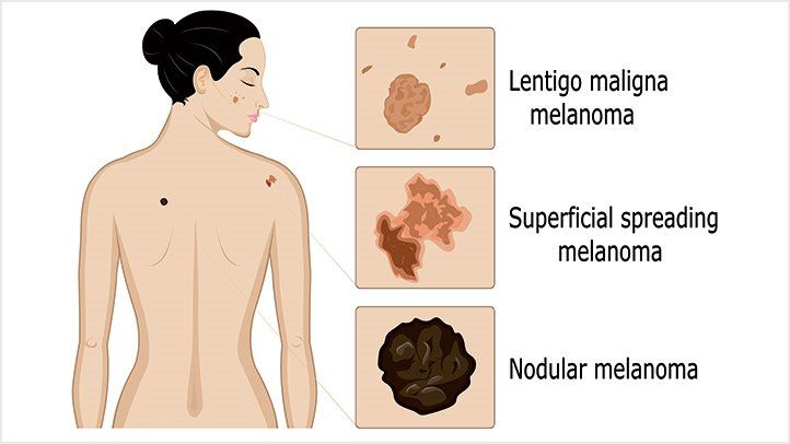 There are four main types of melanom, including a rare but dangerous kind that typically affects people of color. 