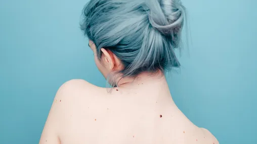 Moles: What to Look For, When to Worry
