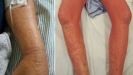 What Are Mycosis Fungoides and Sézary Syndrome? Symptoms, Causes, Diagnosis, Treatment, and Prevention